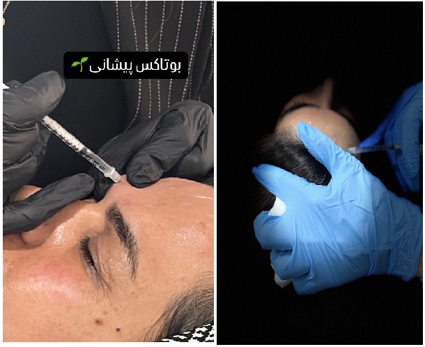 تزریق بوتاکس