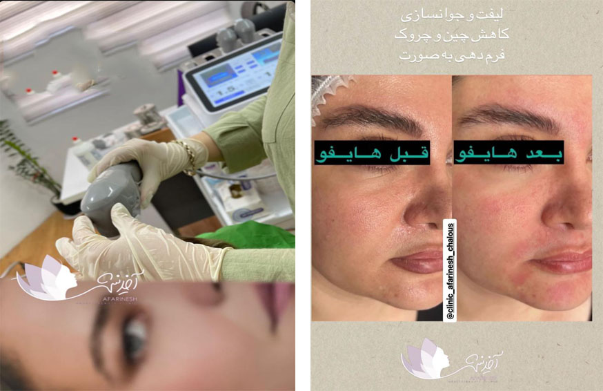  هایفوتراپی