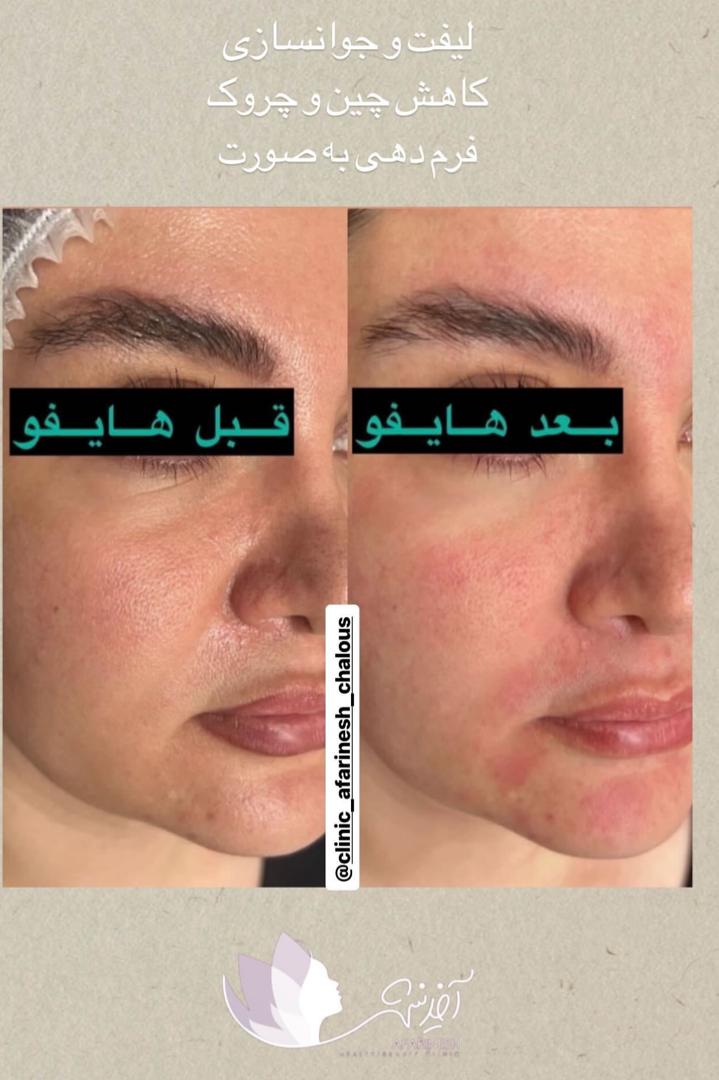 هایفو