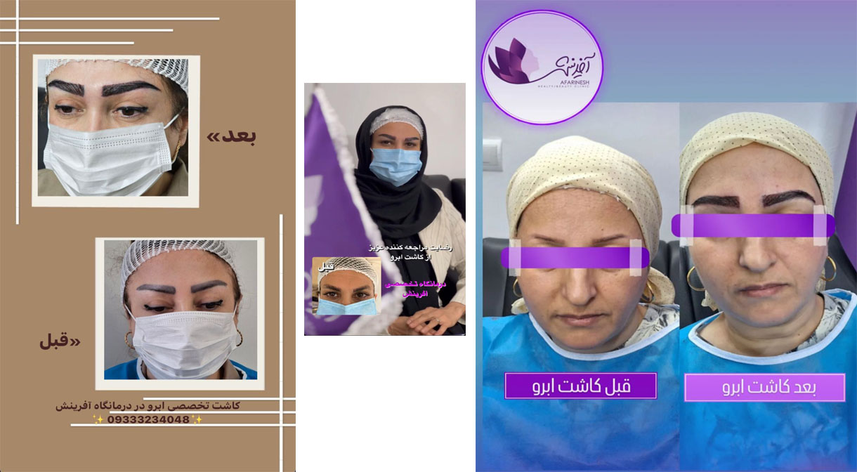  کاشت ابرو