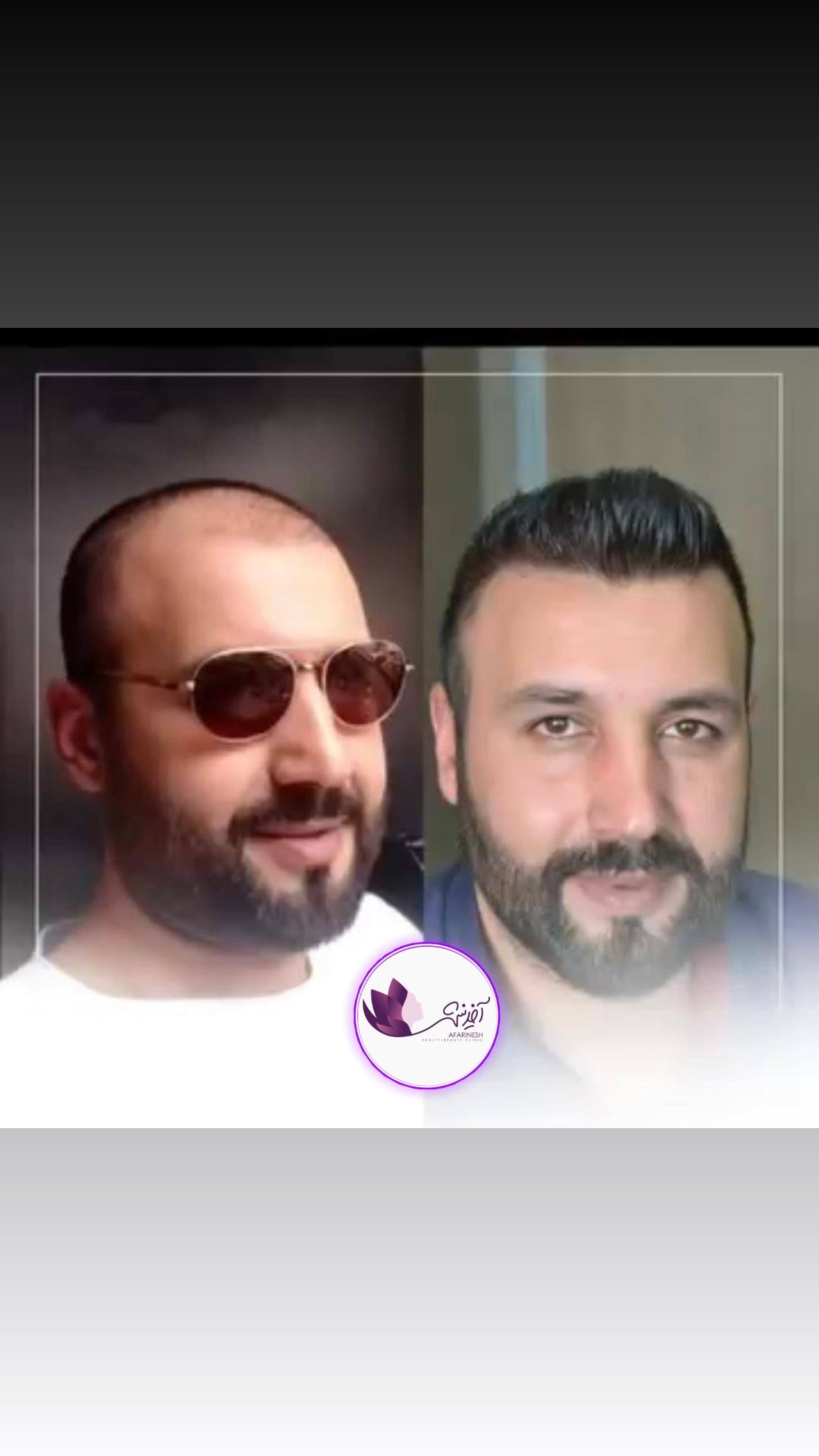 کاشت مو