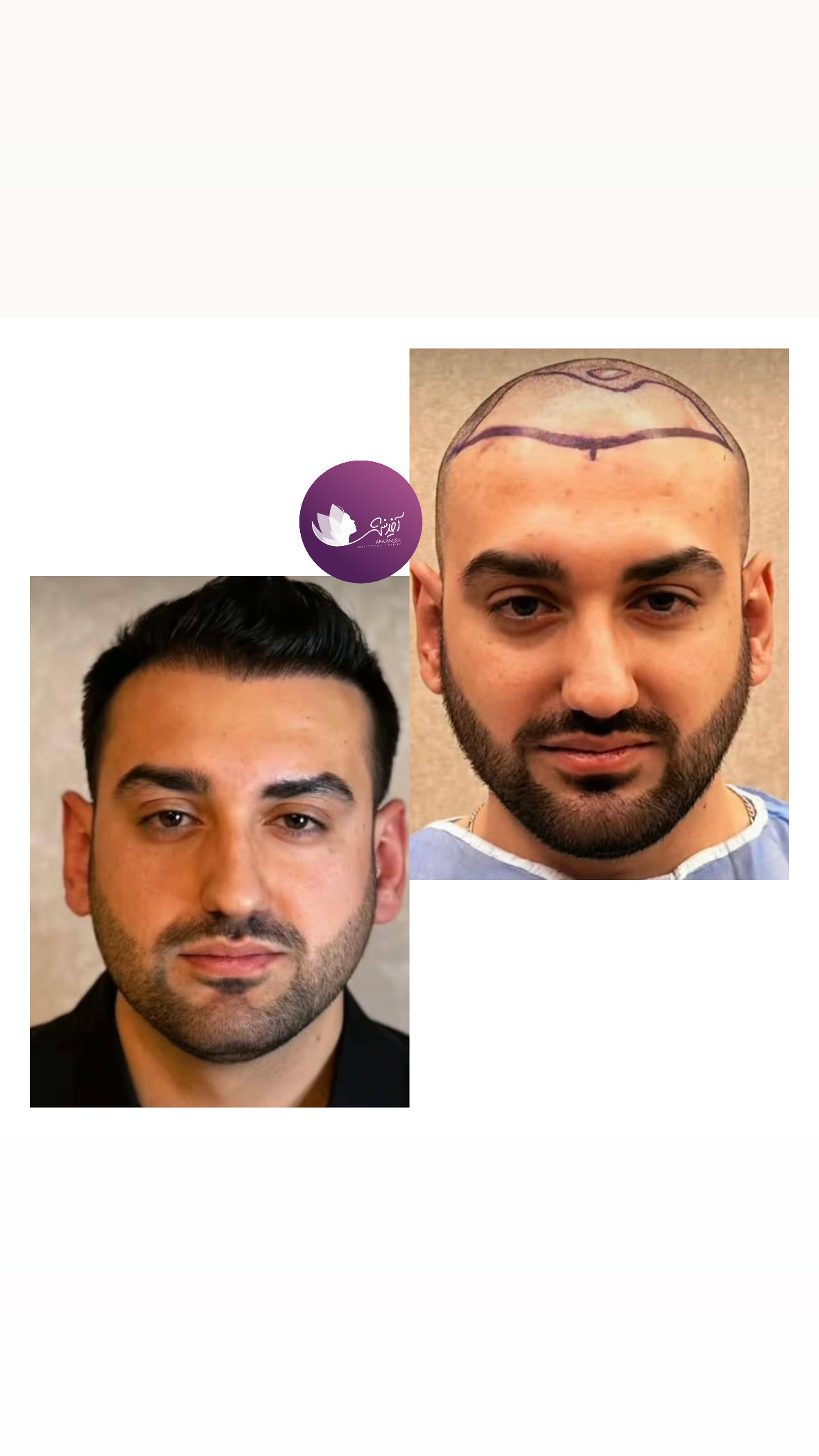کاشت مو