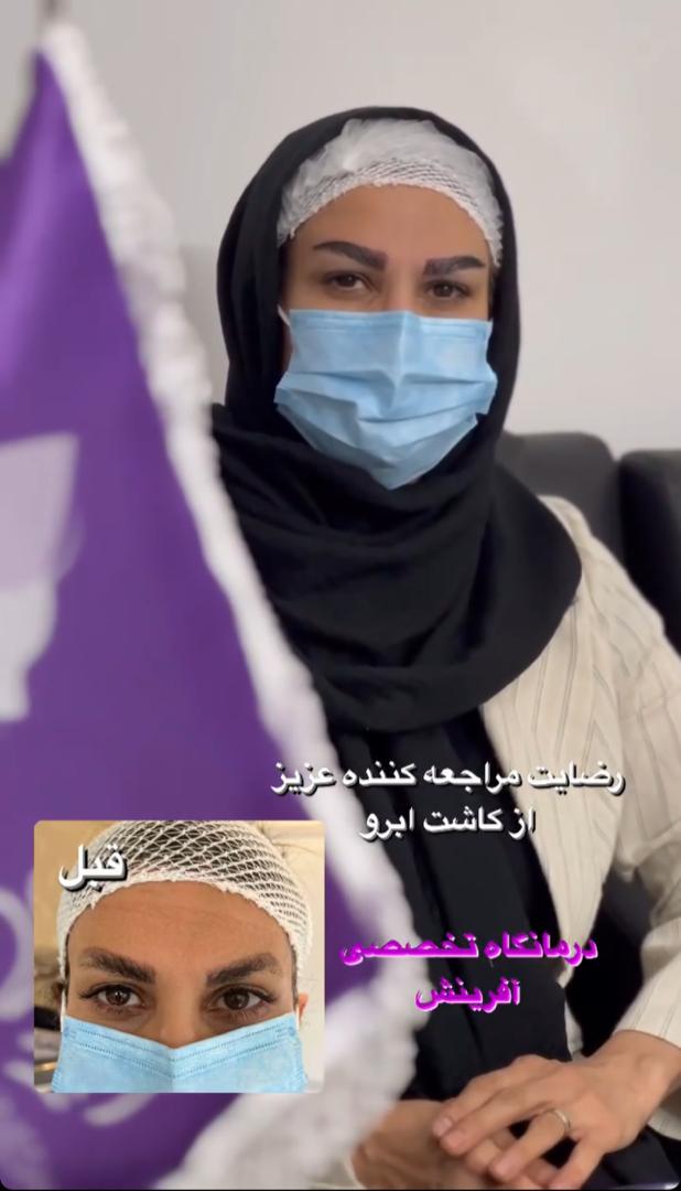 کاشت ابرو