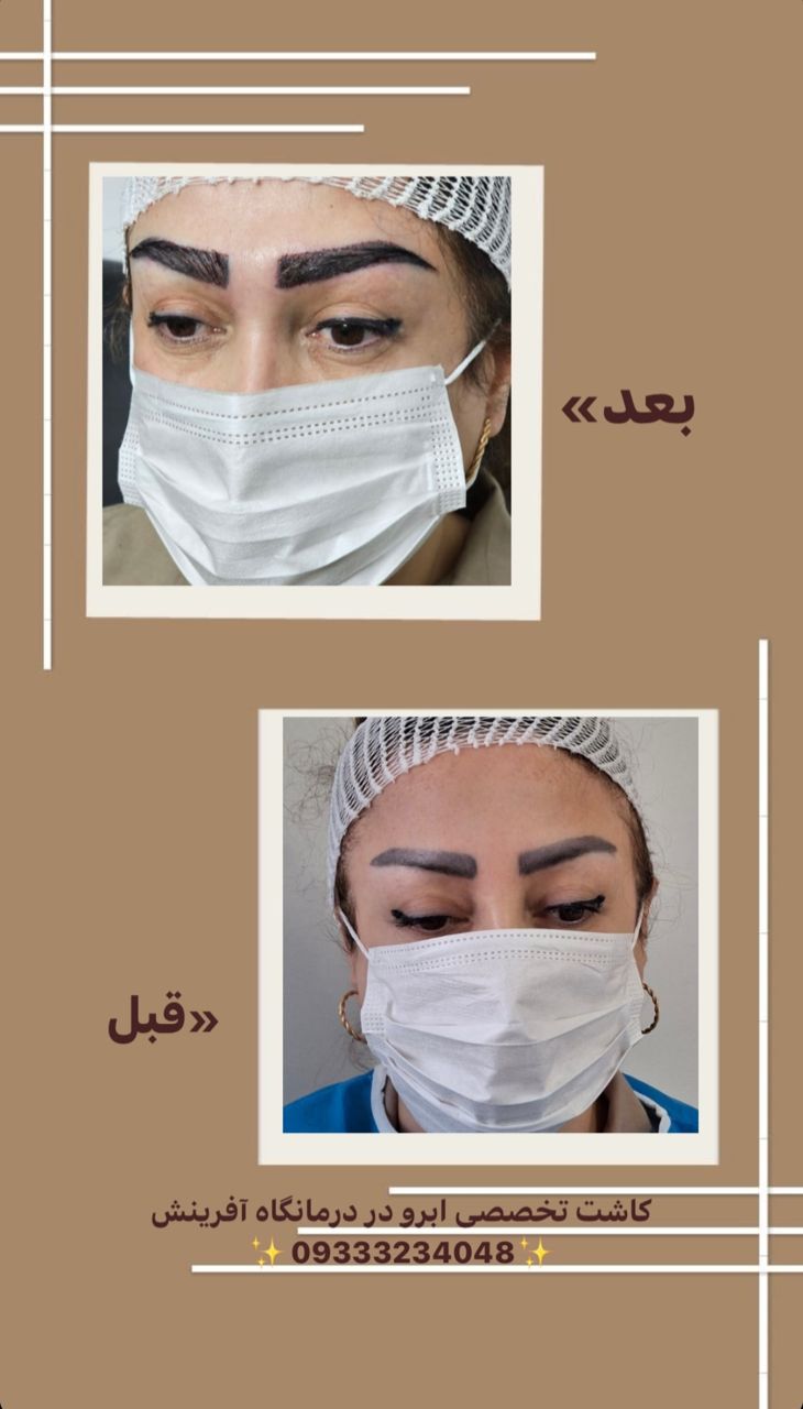 کاشت ابرو