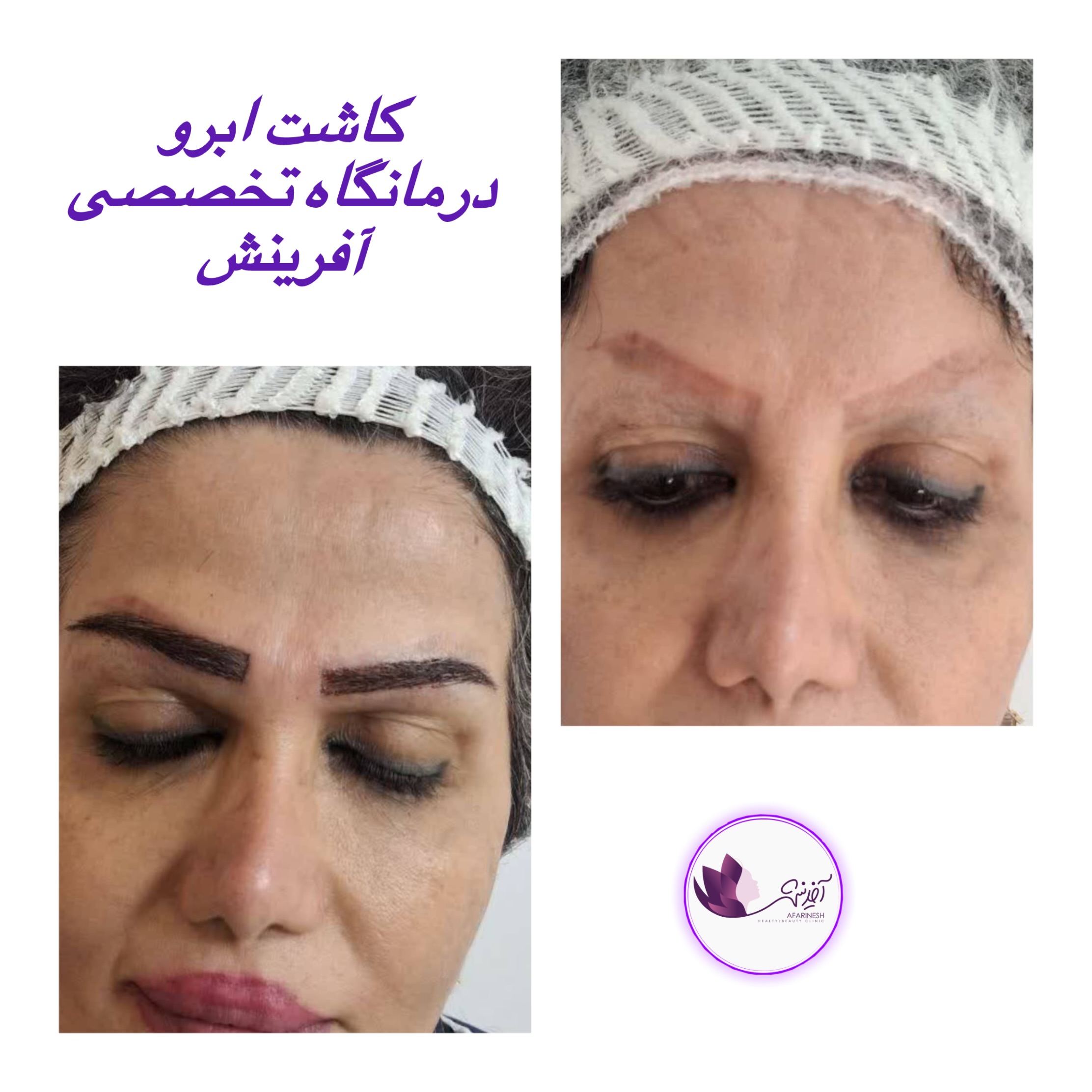 کاشت ابرو