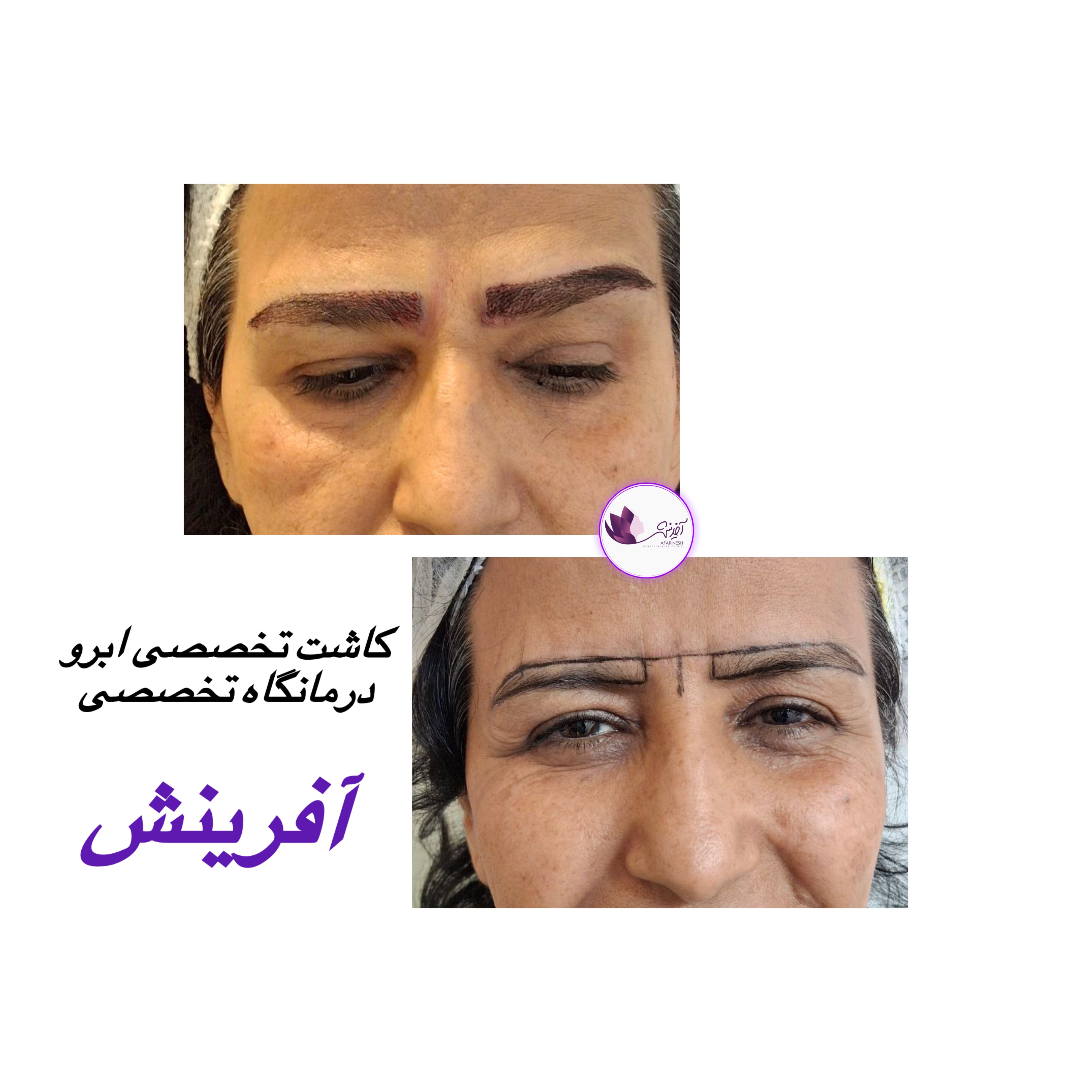 کاشت ابرو کاشت ابرو