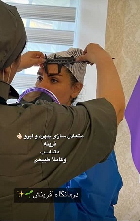 کاشت ابرو