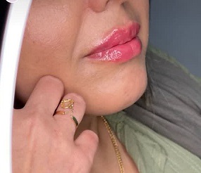 فیلر لب
