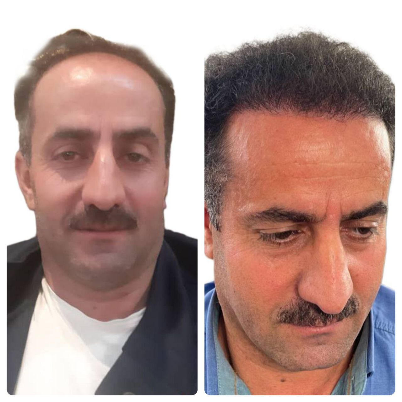 کاشت مو