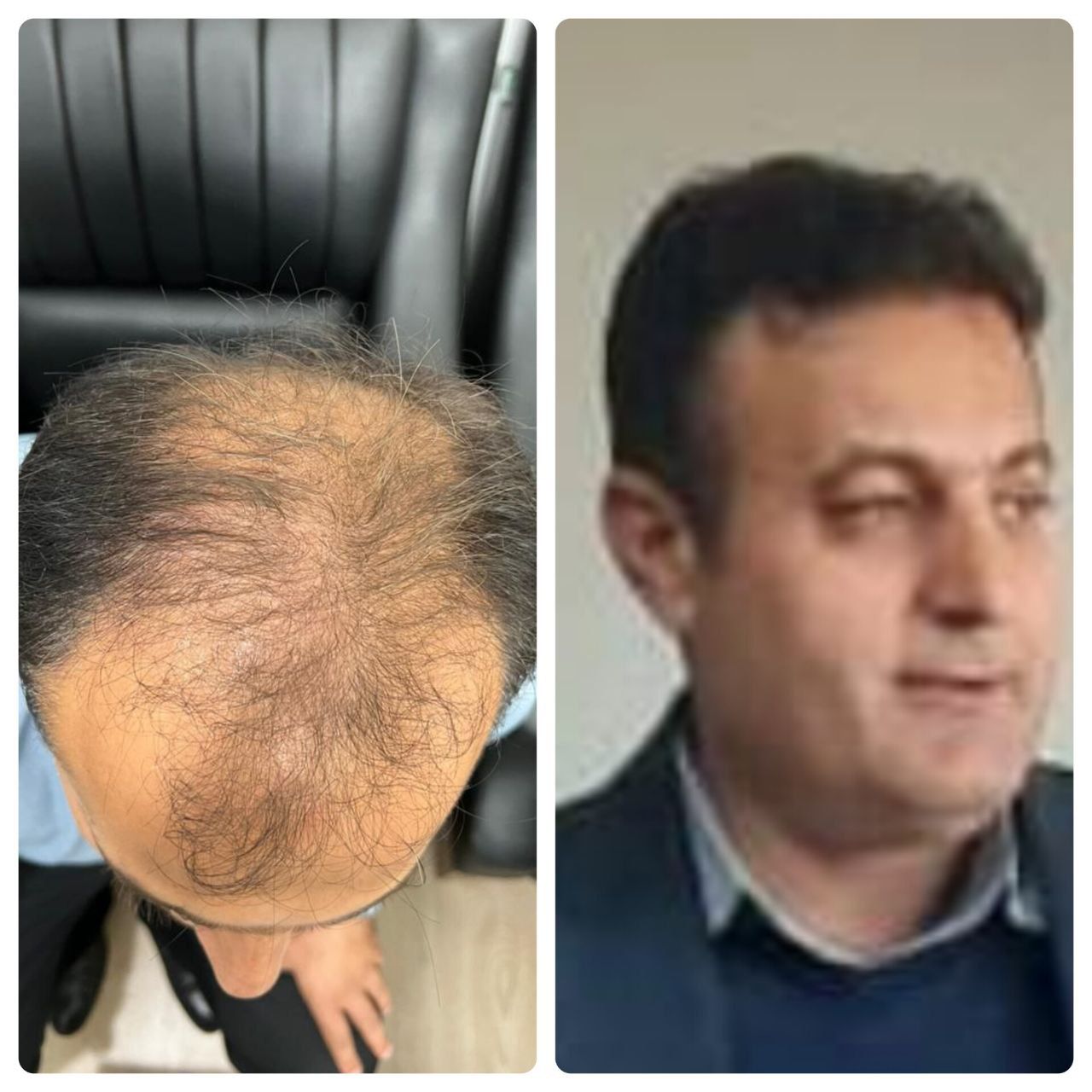 کاشت مو