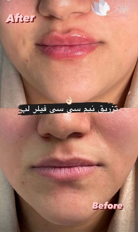 فیلر لب