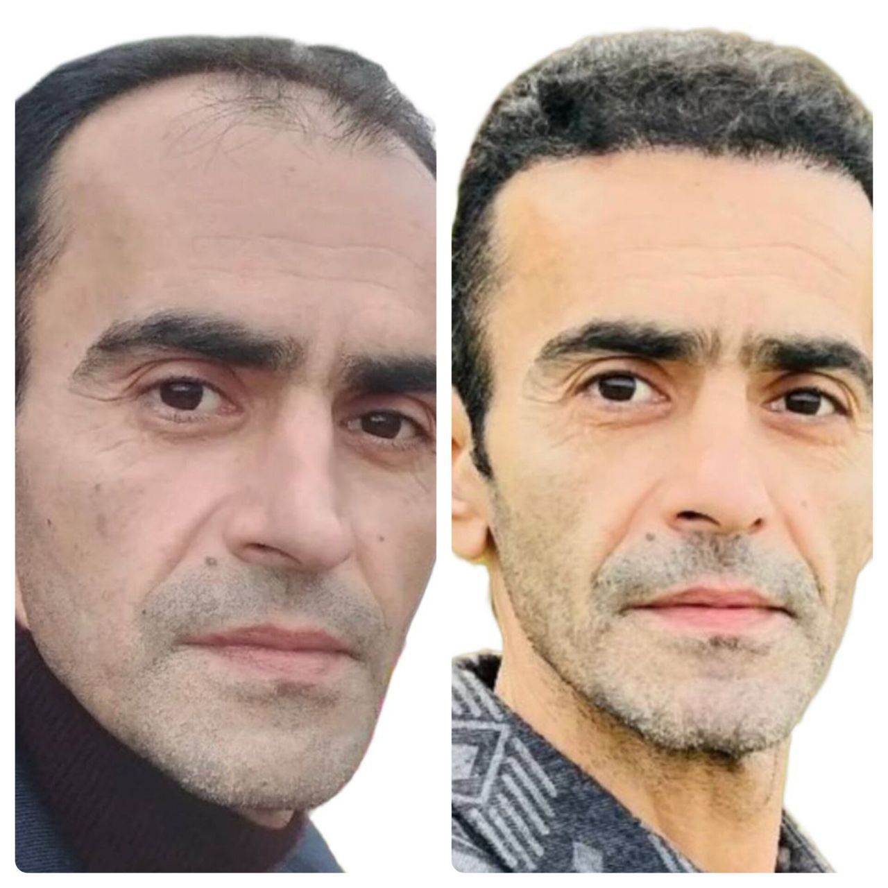 کاشت مو