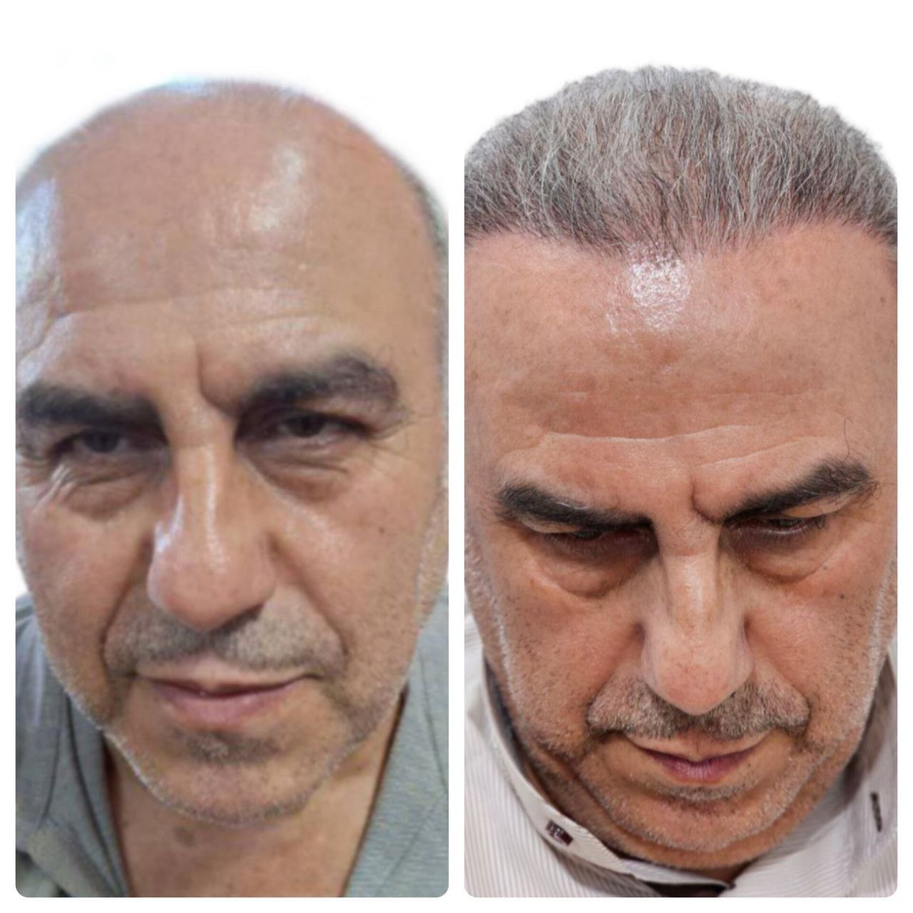 کاشت مو