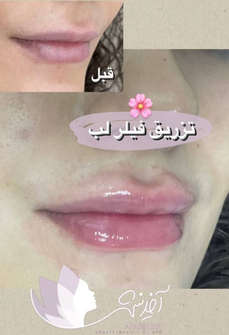 فیلر لب