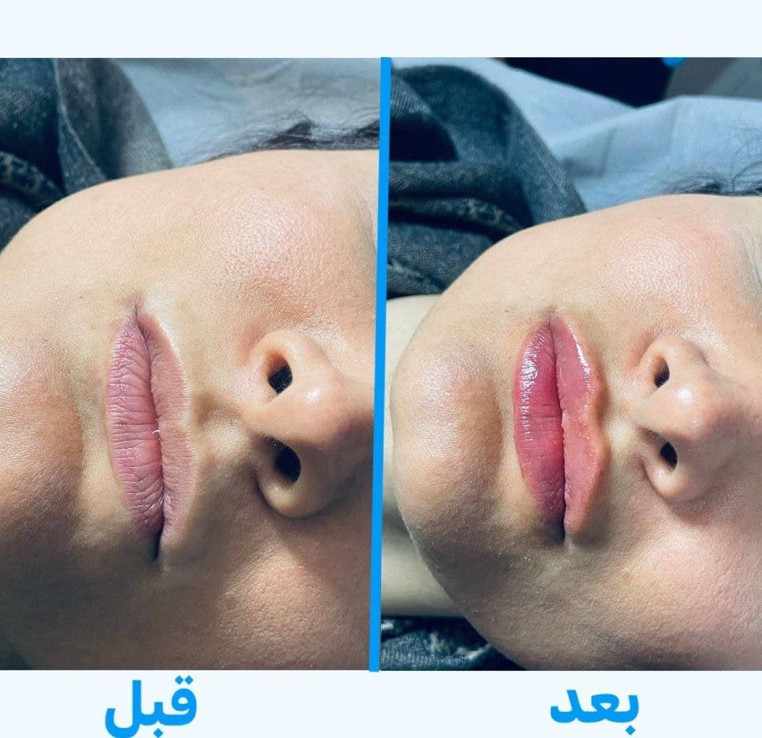فیلر لب