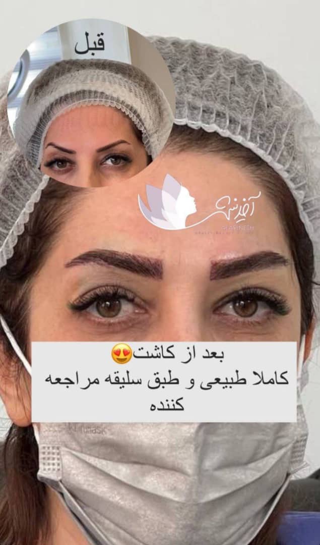کاشت ابرو