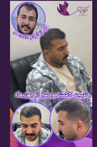 کاشت مو
