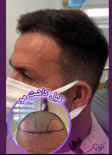 کاشت مو
