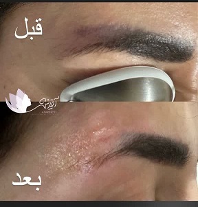 ریمو وتتو