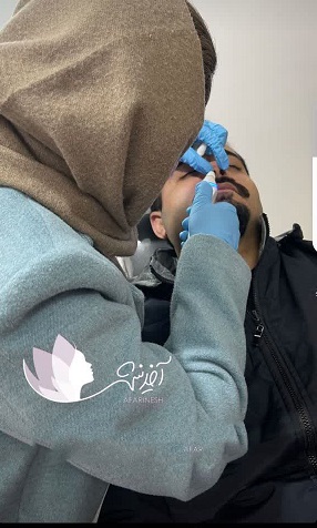 رفع خال