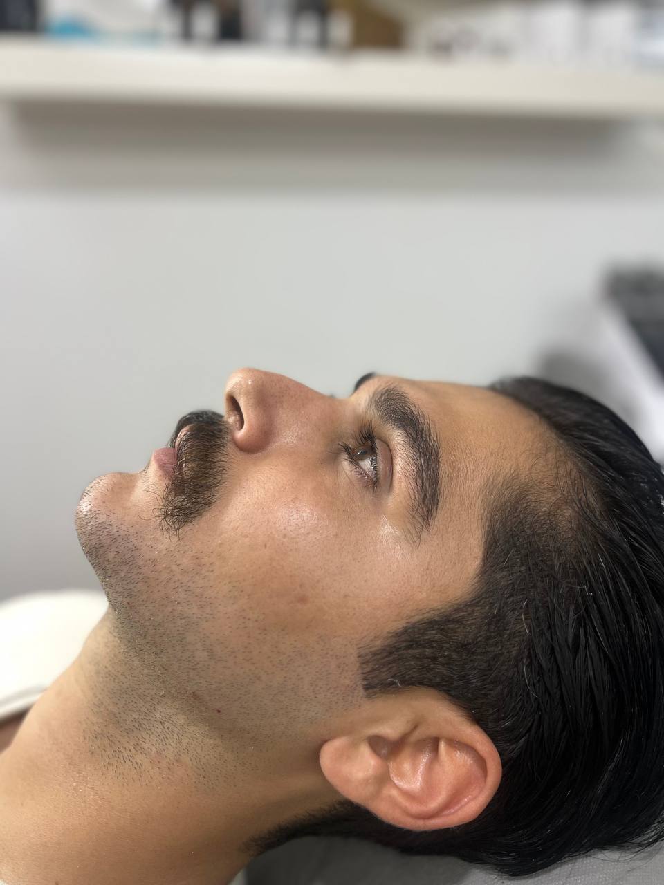 تزریق فیلر زاویه فک