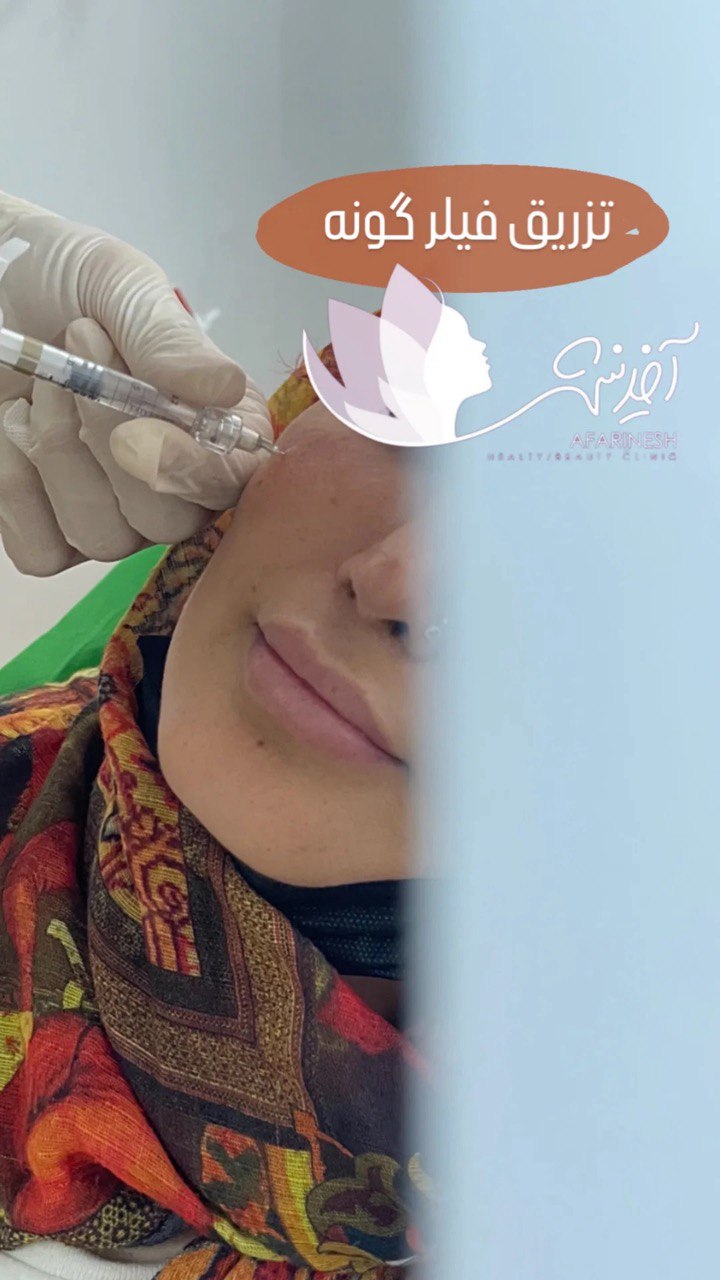 تزریق فیلر گونه