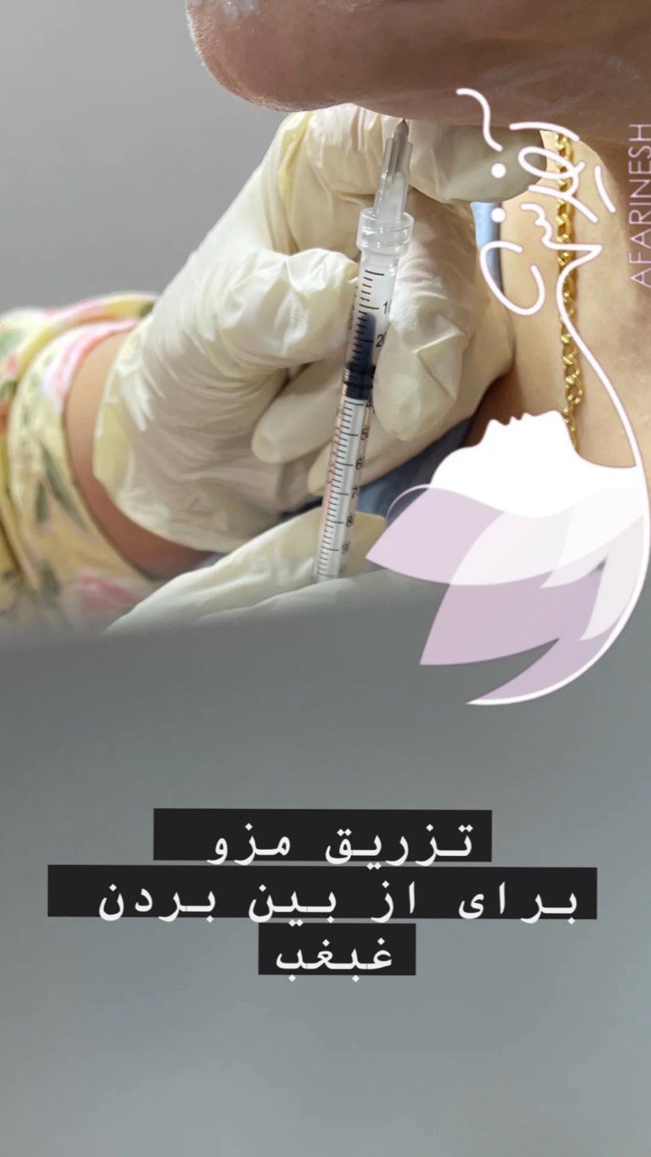 تزریق مزو برای از بین بردن غبغب