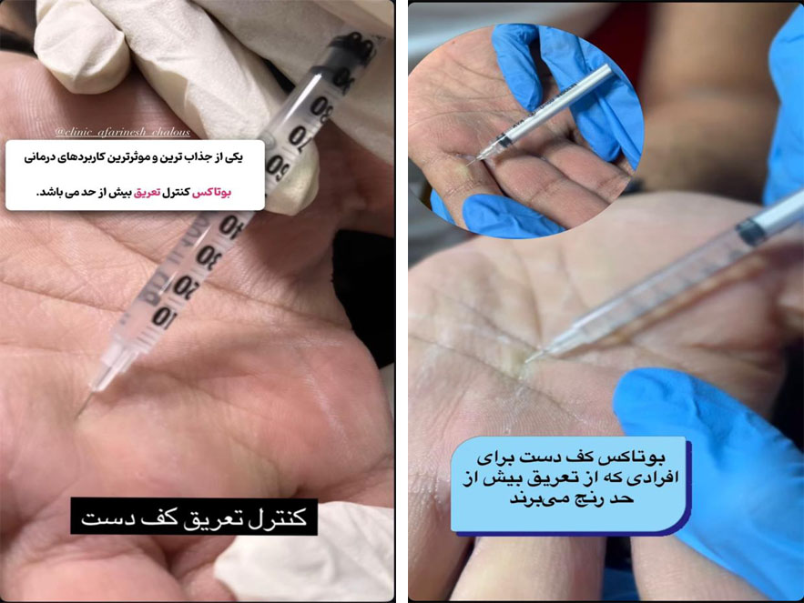 تعریق کف