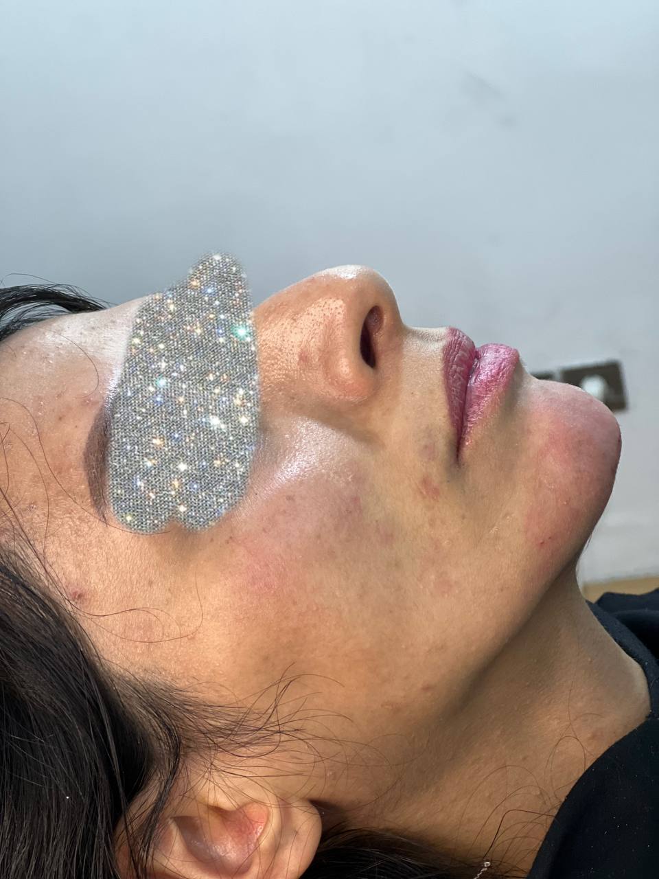 فیلر چانه