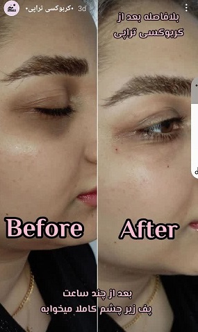 کربوکسی تراپی