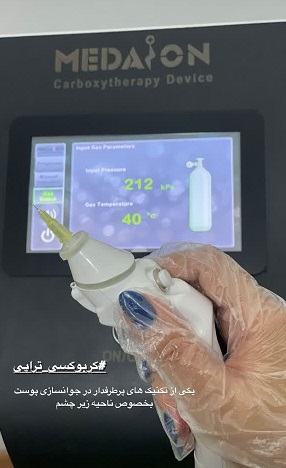 کربوکسی تراپی