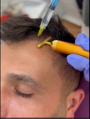  مزوتراپی مو