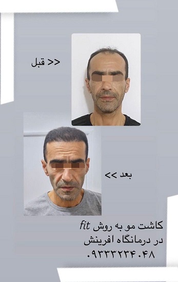 فیلم کارهای زیبایی - کاشت مو